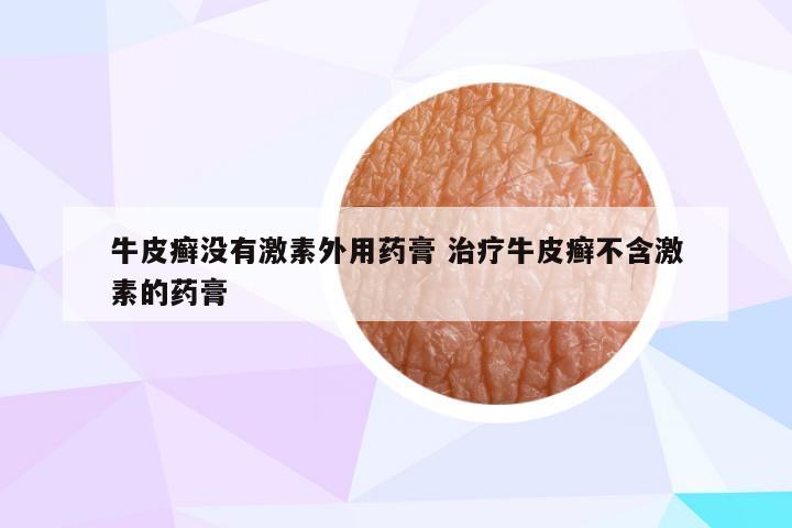 牛皮癣没有激素外用药膏 治疗牛皮癣不含激素的药膏