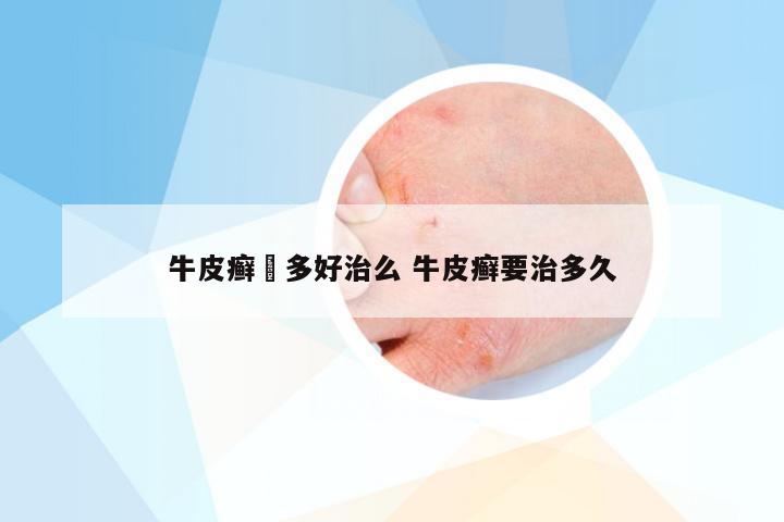 牛皮癣痟多好治么 牛皮癣要治多久