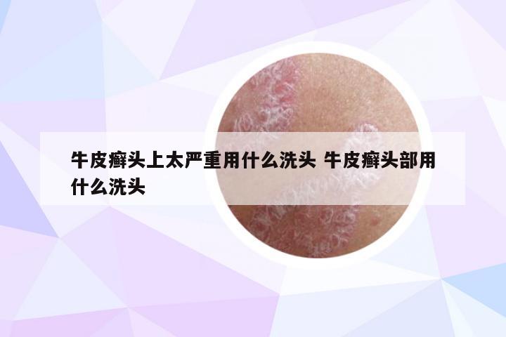 牛皮癣头上太严重用什么洗头 牛皮癣头部用什么洗头