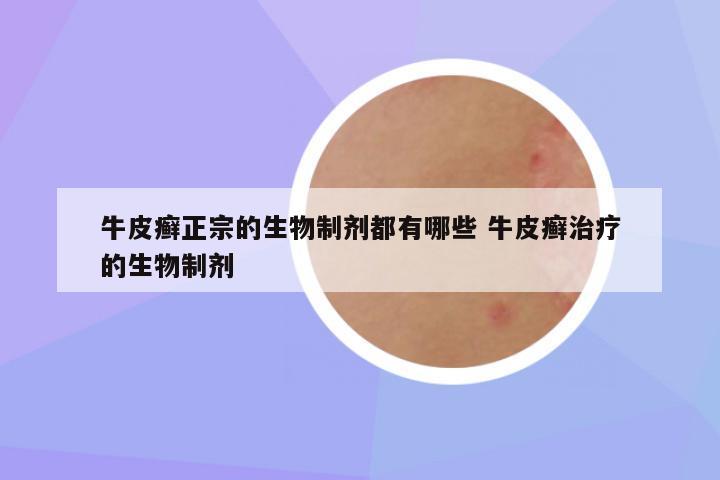 牛皮癣正宗的生物制剂都有哪些 牛皮癣治疗的生物制剂