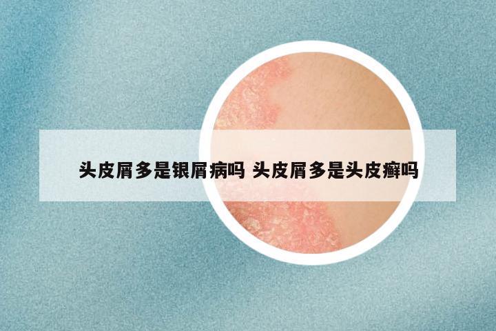 头皮屑多是银屑病吗 头皮屑多是头皮癣吗