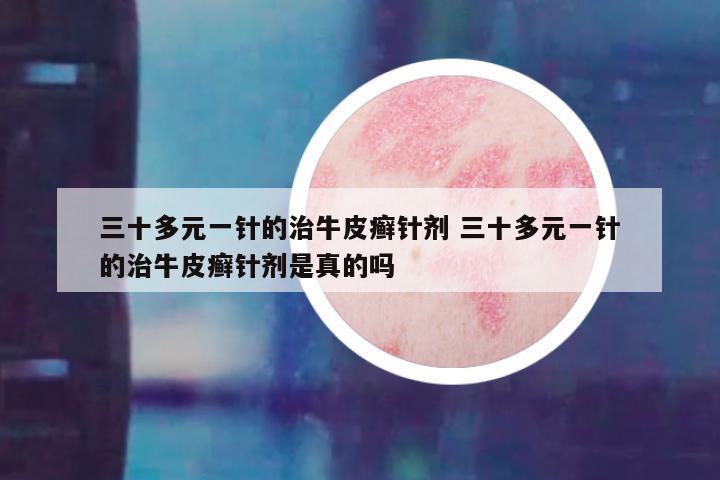 三十多元一针的治牛皮癣针剂 三十多元一针的治牛皮癣针剂是真的吗