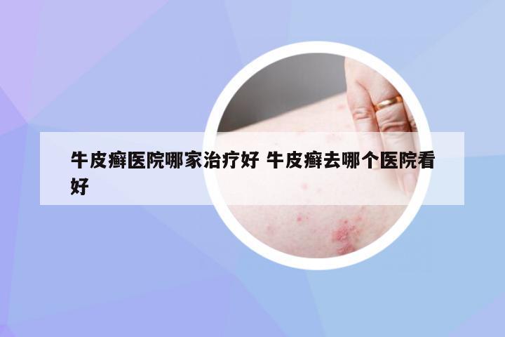 牛皮癣医院哪家治疗好 牛皮癣去哪个医院看好