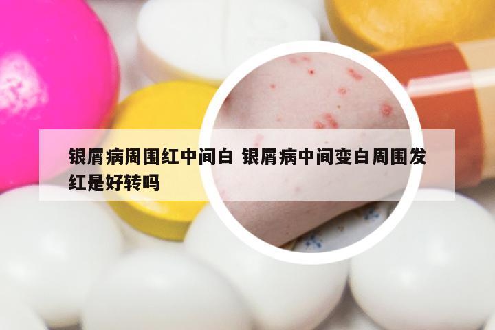 银屑病周围红中间白 银屑病中间变白周围发红是好转吗