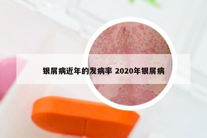 银屑病近年的发病率 2020年银屑病