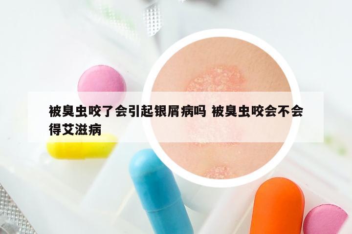 被臭虫咬了会引起银屑病吗 被臭虫咬会不会得艾滋病