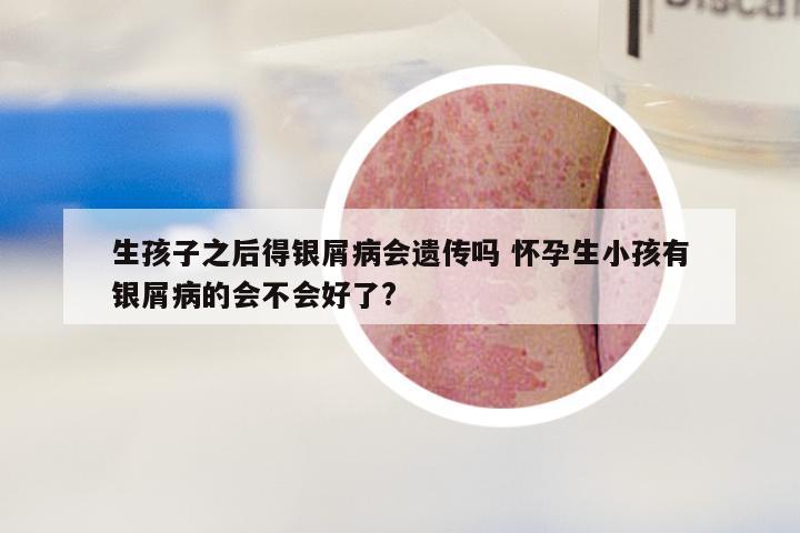 生孩子之后得银屑病会遗传吗 怀孕生小孩有银屑病的会不会好了?