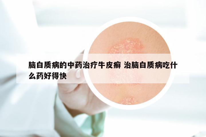 脑白质病的中药治疗牛皮癣 治脑白质病吃什么药好得快