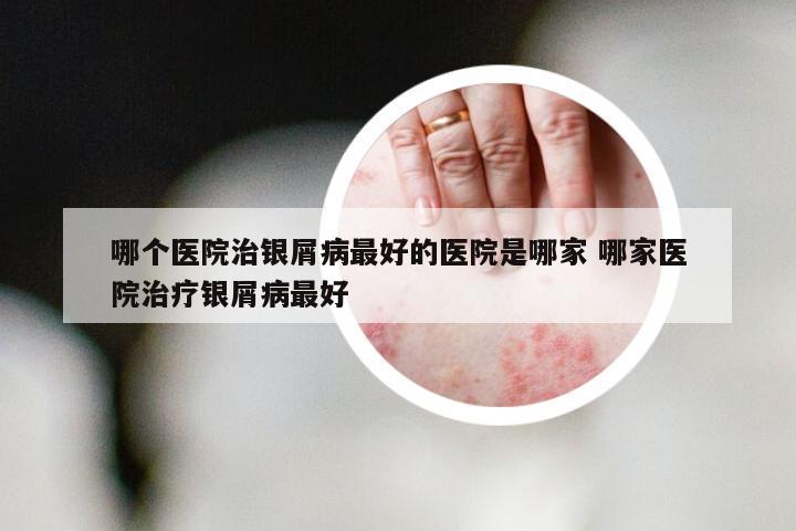 哪个医院治银屑病最好的医院是哪家 哪家医院治疗银屑病最好