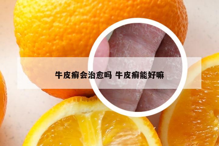牛皮癣会治愈吗 牛皮癣能好嘛