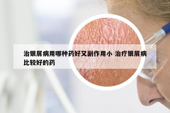 治银屑病用哪种药好又副作用小 治疗银屑病比较好的药