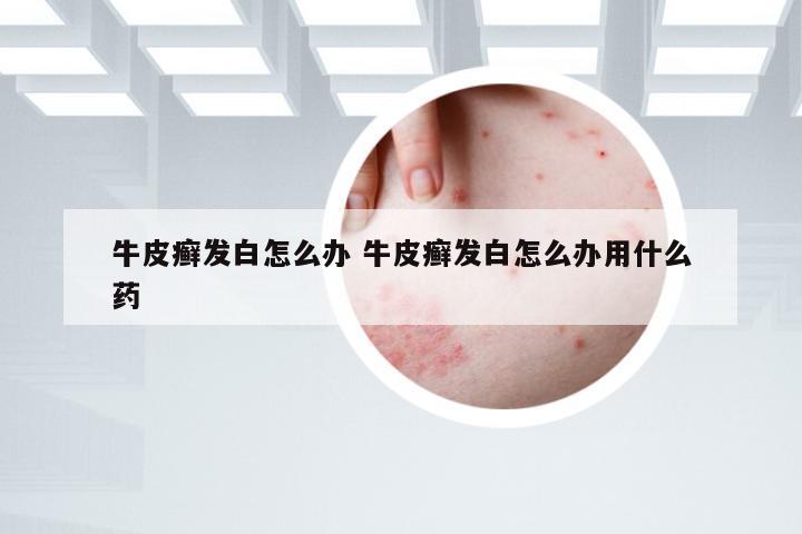 牛皮癣发白怎么办 牛皮癣发白怎么办用什么药