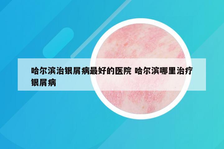 哈尔滨治银屑病最好的医院 哈尔滨哪里治疗银屑病