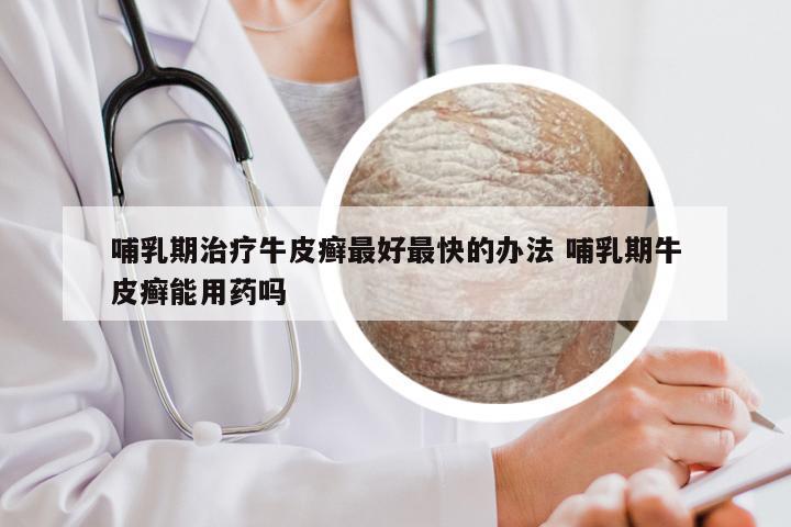哺乳期治疗牛皮癣最好最快的办法 哺乳期牛皮癣能用药吗