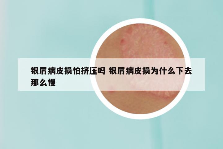 银屑病皮损怕挤压吗 银屑病皮损为什么下去那么慢