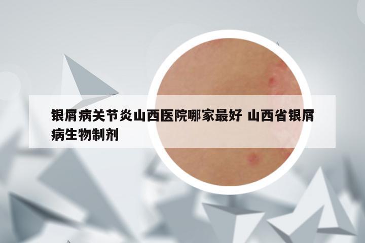 银屑病关节炎山西医院哪家最好 山西省银屑病生物制剂
