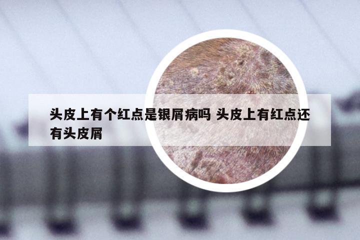 头皮上有个红点是银屑病吗 头皮上有红点还有头皮屑