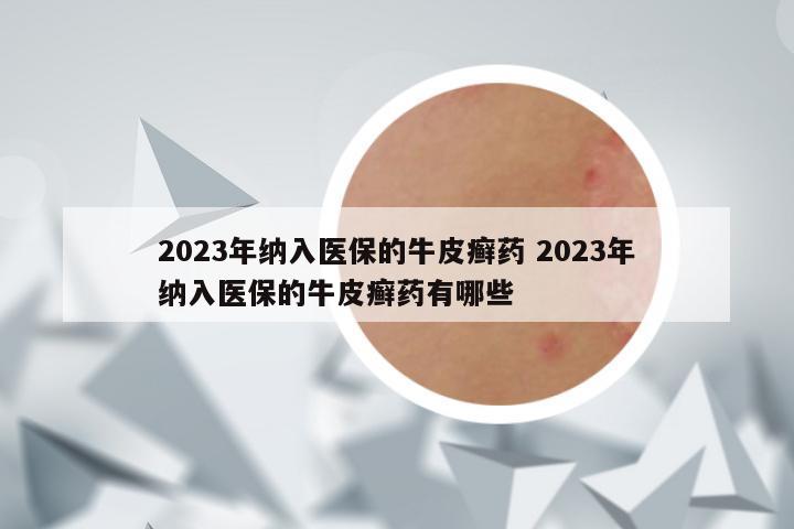 2023年纳入医保的牛皮癣药 2023年纳入医保的牛皮癣药有哪些
