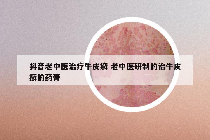 抖音老中医治疗牛皮癣 老中医研制的治牛皮癣的药膏