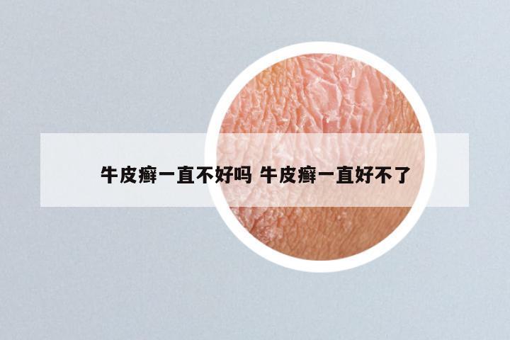 牛皮癣一直不好吗 牛皮癣一直好不了
