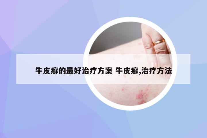 牛皮癣的最好治疗方案 牛皮癣,治疗方法