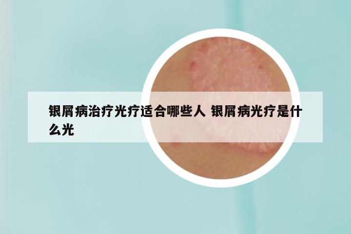 银屑病治疗光疗适合哪些人 银屑病光疗是什么光