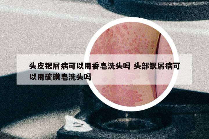 头皮银屑病可以用香皂洗头吗 头部银屑病可以用硫磺皂洗头吗