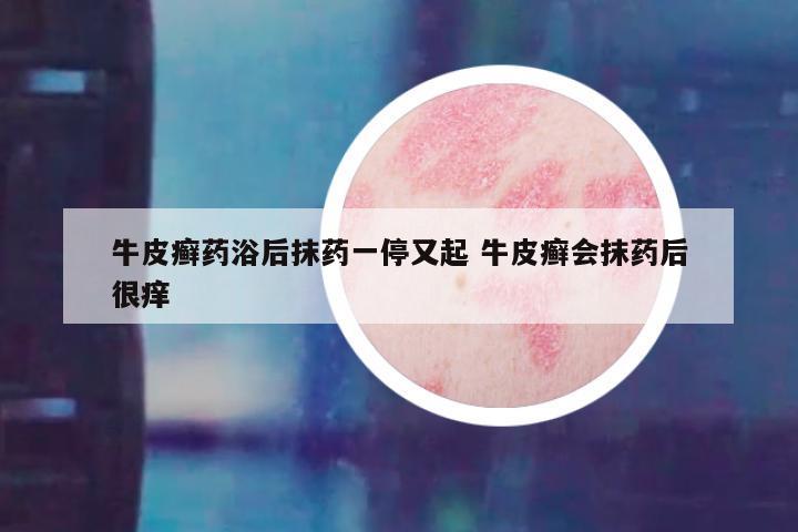 牛皮癣药浴后抹药一停又起 牛皮癣会抹药后很痒
