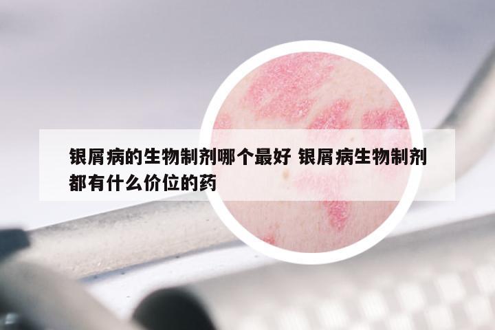 银屑病的生物制剂哪个最好 银屑病生物制剂都有什么价位的药