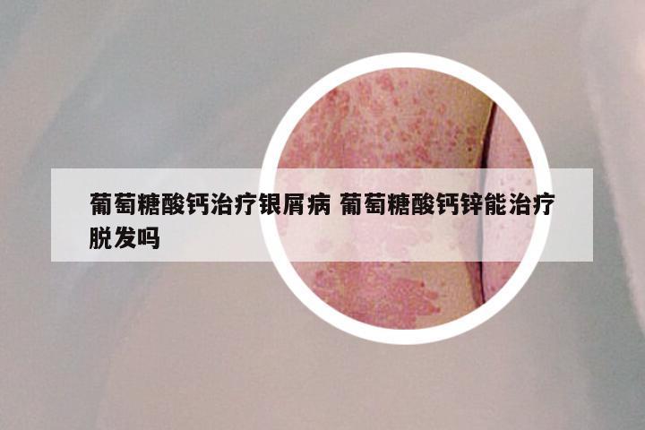 葡萄糖酸钙治疗银屑病 葡萄糖酸钙锌能治疗脱发吗