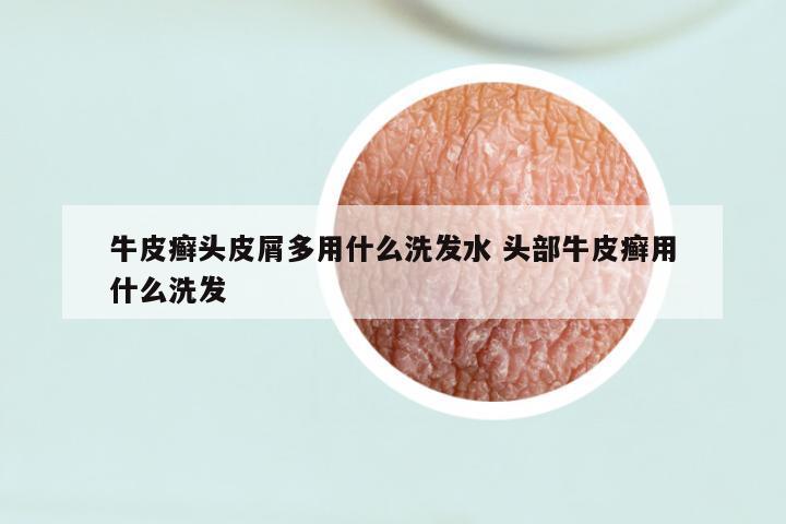 牛皮癣头皮屑多用什么洗发水 头部牛皮癣用什么洗发