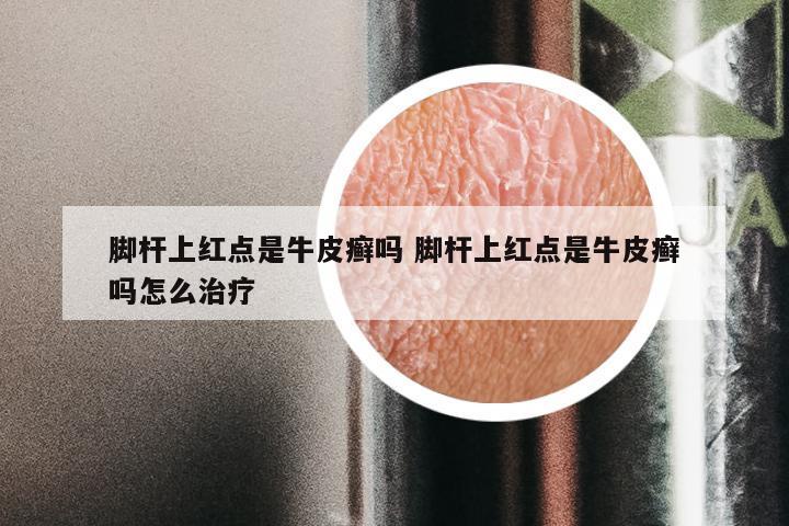 脚杆上红点是牛皮癣吗 脚杆上红点是牛皮癣吗怎么治疗
