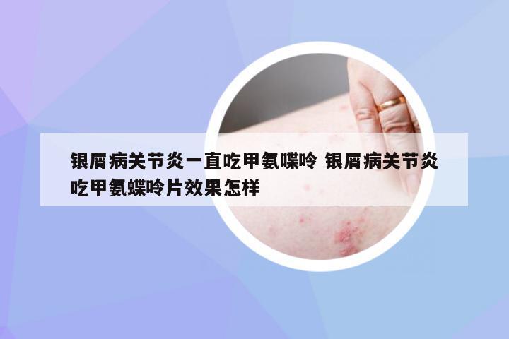 银屑病关节炎一直吃甲氨喋呤 银屑病关节炎吃甲氨蝶呤片效果怎样