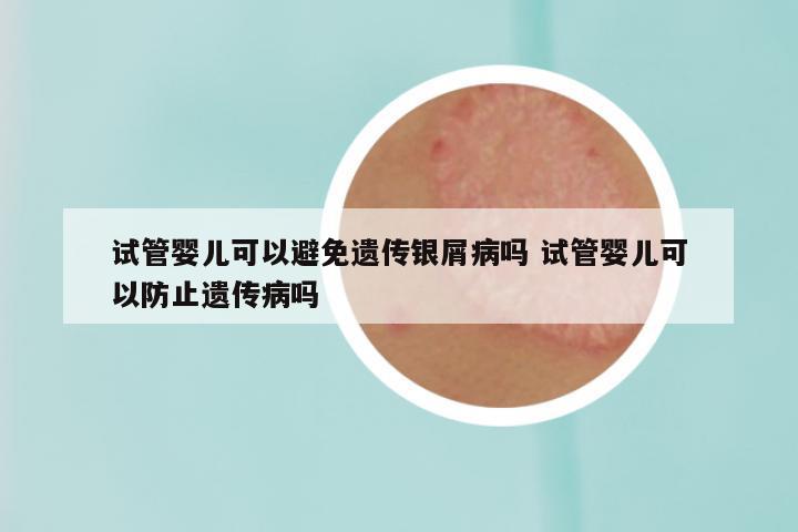 试管婴儿可以避免遗传银屑病吗 试管婴儿可以防止遗传病吗