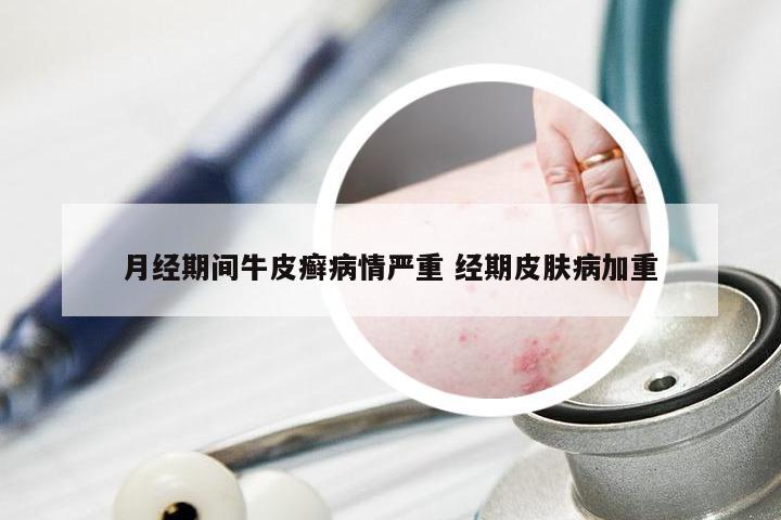 月经期间牛皮癣病情严重 经期皮肤病加重