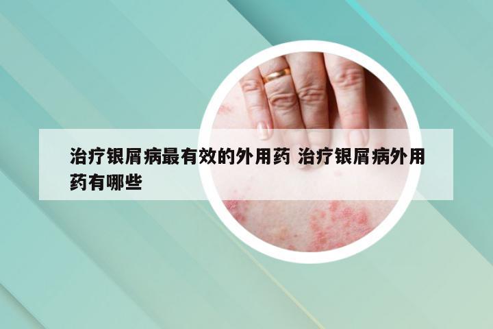 治疗银屑病最有效的外用药 治疗银屑病外用药有哪些