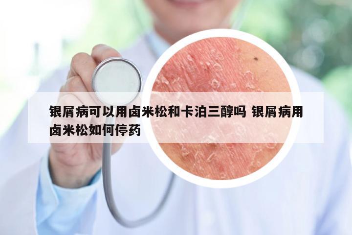 银屑病可以用卤米松和卡泊三醇吗 银屑病用卤米松如何停药