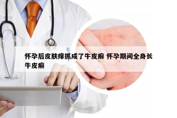 怀孕后皮肤痒抓成了牛皮癣 怀孕期间全身长牛皮癣
