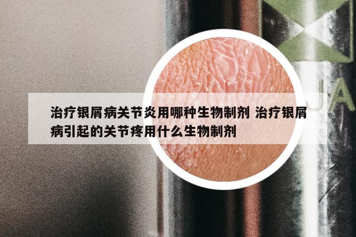治疗银屑病关节炎用哪种生物制剂 治疗银屑病引起的关节疼用什么生物制剂