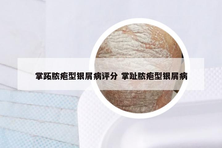 掌跖脓疱型银屑病评分 掌趾脓疱型银屑病