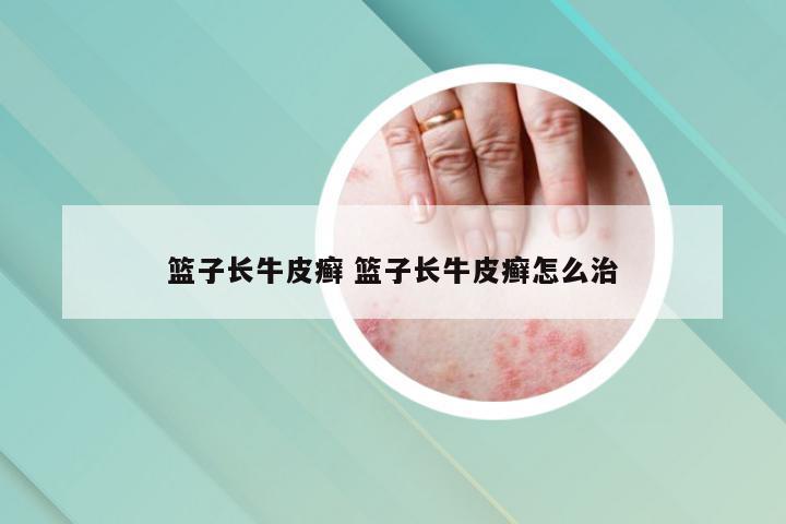 篮子长牛皮癣 篮子长牛皮癣怎么治