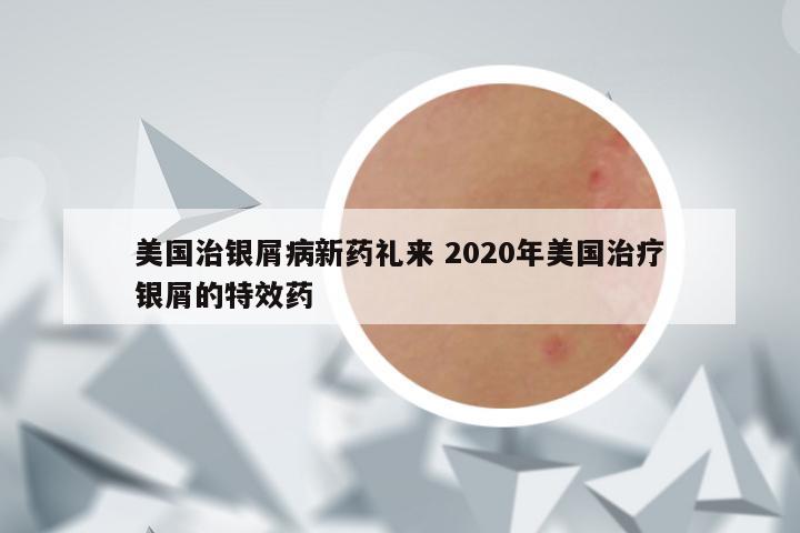美国治银屑病新药礼来 2020年美国治疗银屑的特效药