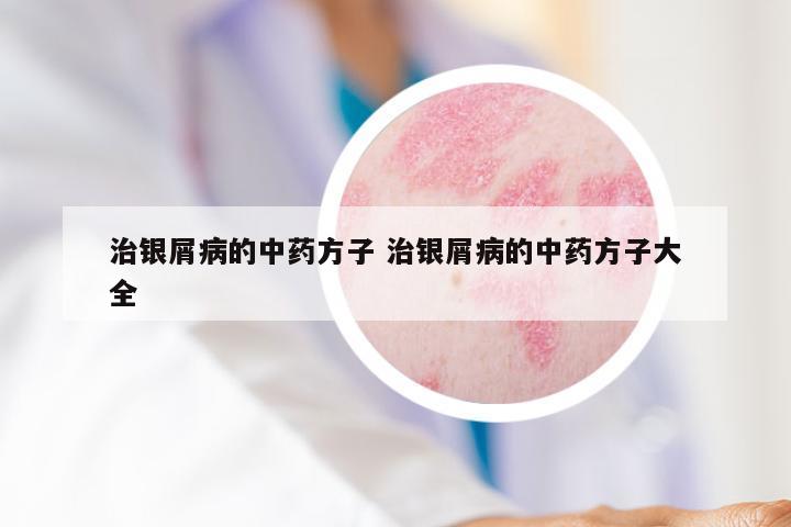 治银屑病的中药方子 治银屑病的中药方子大全