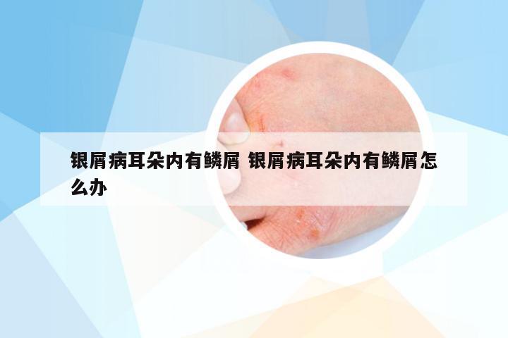 银屑病耳朵内有鳞屑 银屑病耳朵内有鳞屑怎么办
