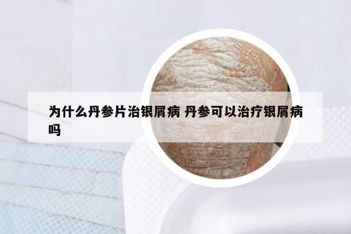 为什么丹参片治银屑病 丹参可以治疗银屑病吗