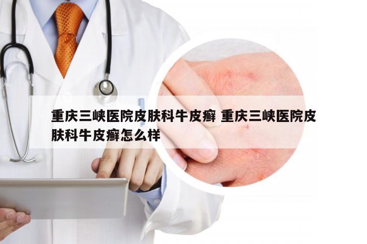 重庆三峡医院皮肤科牛皮癣 重庆三峡医院皮肤科牛皮癣怎么样