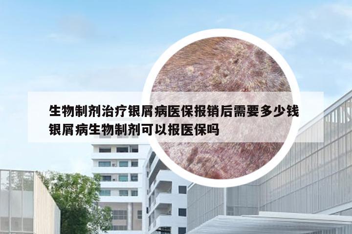 生物制剂治疗银屑病医保报销后需要多少钱 银屑病生物制剂可以报医保吗