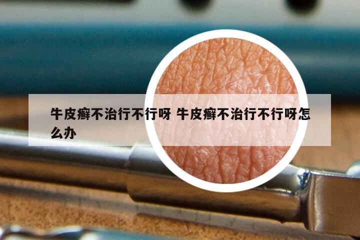 牛皮癣不治行不行呀 牛皮癣不治行不行呀怎么办