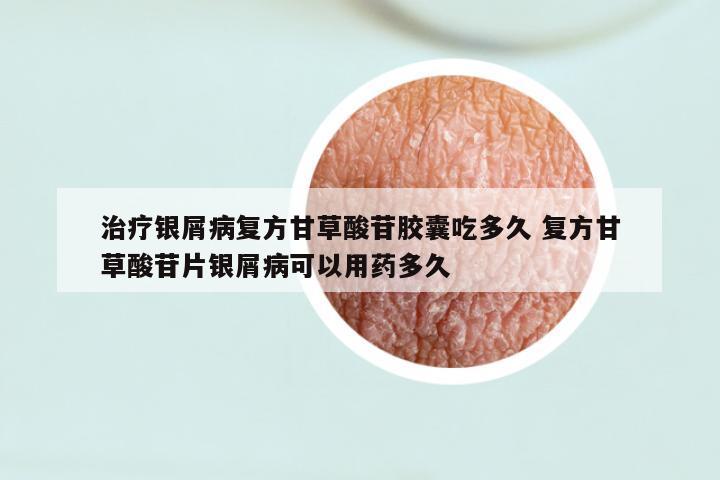 治疗银屑病复方甘草酸苷胶囊吃多久 复方甘草酸苷片银屑病可以用药多久