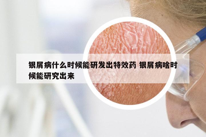 银屑病什么时候能研发出特效药 银屑病啥时候能研究出来